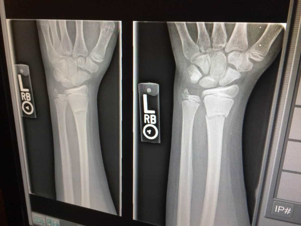 Can You Run with a Broken Hand?