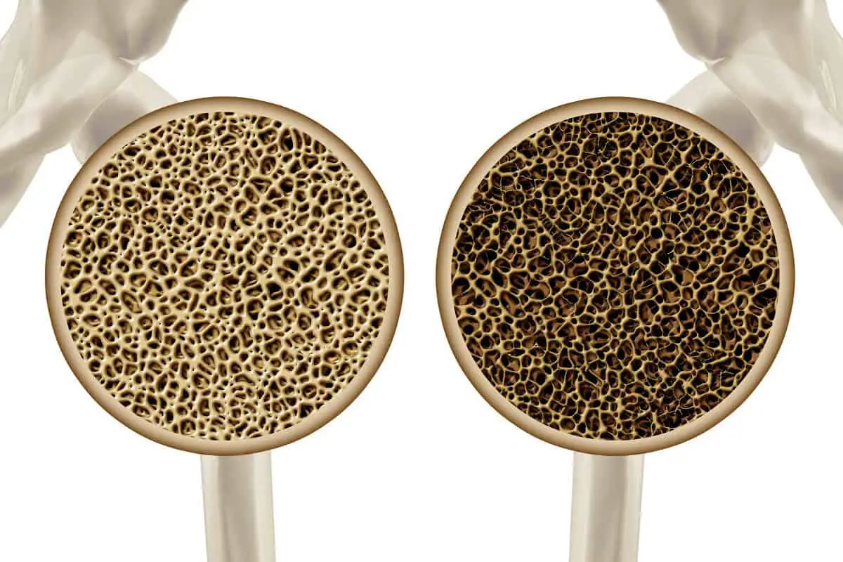 Is Resistance Training Good for Osteoporosis?